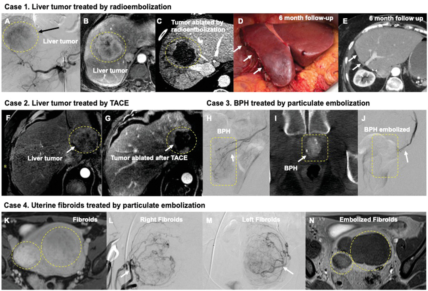 FIBROID EMBOLIZATION IN THE UTERUS