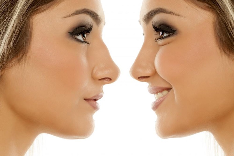 6 Reasons You Should Have a Rhinoplasty