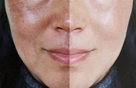 Benefits of hyperpigmentation treatments