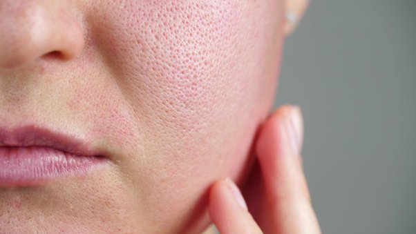 Can Besan Make Your Pores and Skin Dry in the Cold? Here’s How to Use it Properly.