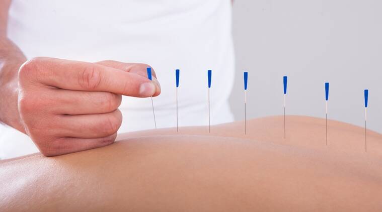 Types Of Acupuncture Therapy | Amsterdam